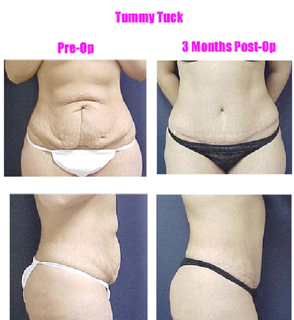 Are you ready for a Tummy Tuck?