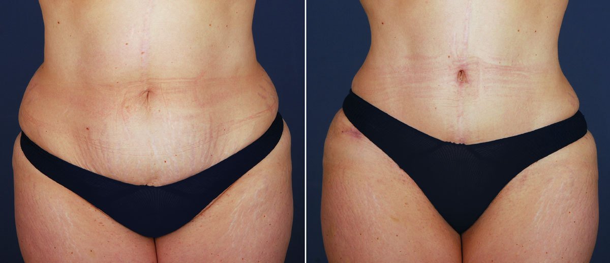 Everything You Need to Know About Hourglass Tummy Tuck
