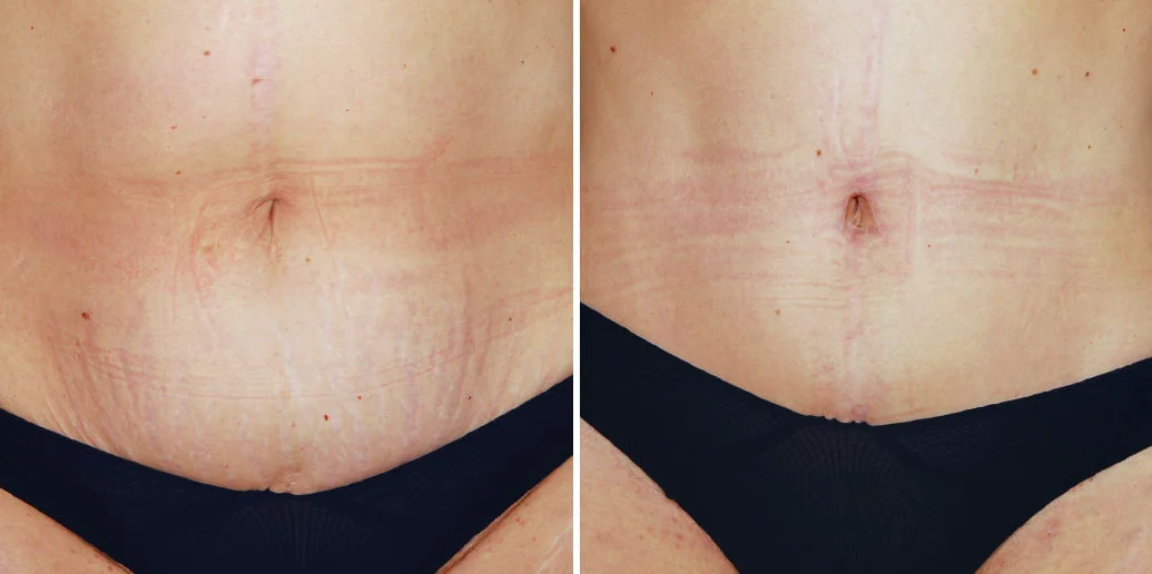 https://www.inlandcosmetic.com/wp-content/uploads/2018/11/tummy-tuck-liposuction-14076-haiavy-close-up-1035-516.jpg.webp