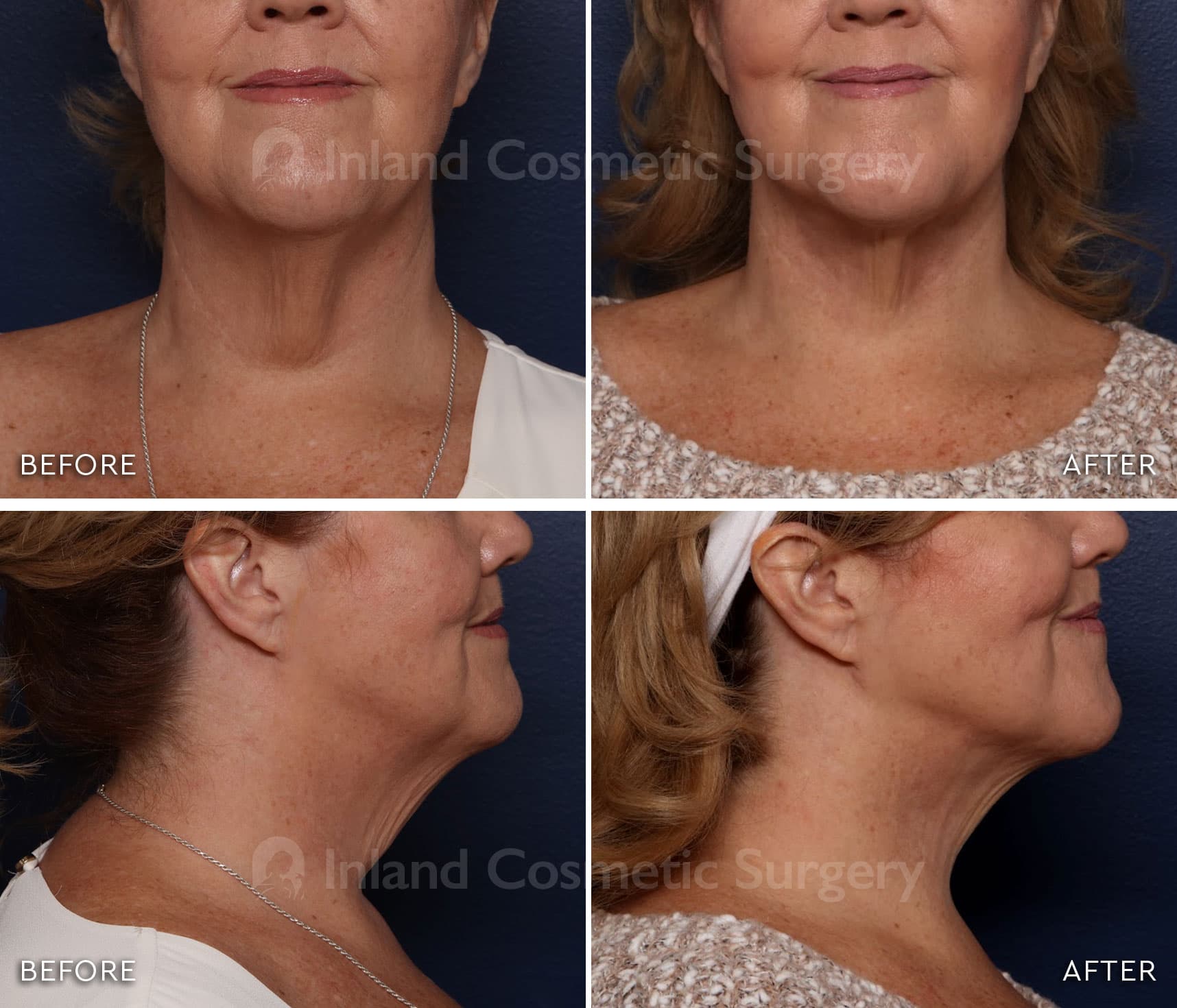 Before & After Photos Subdermal Skin Tightening 3