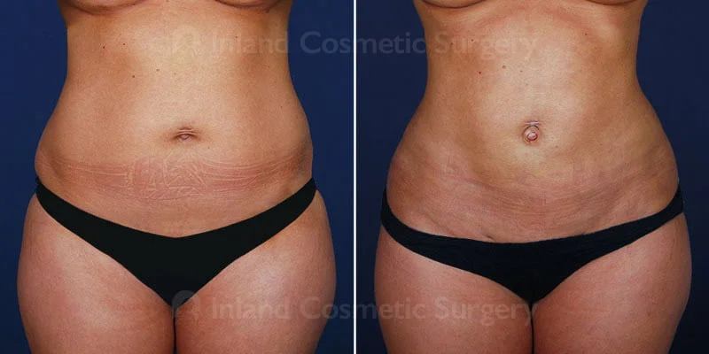 What's the Key to a Superb, Natural-Looking Tummy Tuck? It's All in the  Belly Button. – Inland Cosmetic Surgery