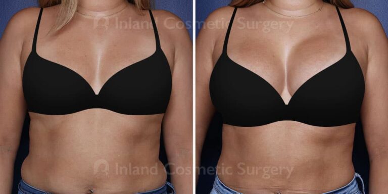 Breast Augmentation In Rancho Cucamonga Inland Cosmetic Surgery