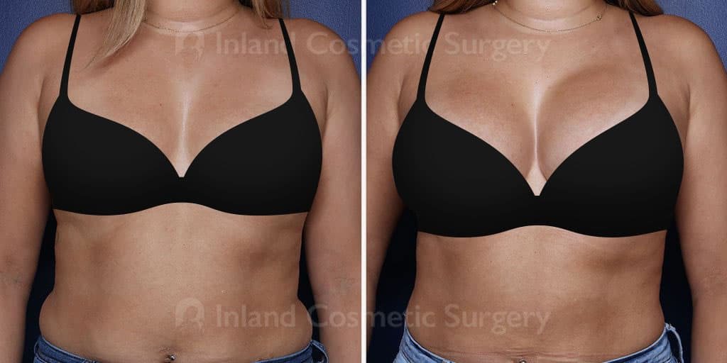 Best places to buy a bra if you've had a breast enlargement