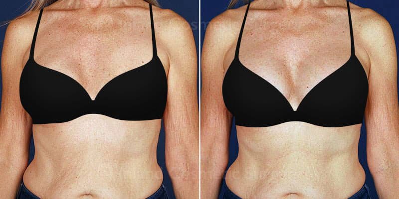 Breast Lift Recovery – Sacramento Healing Period - The Plastic Surgery  Center