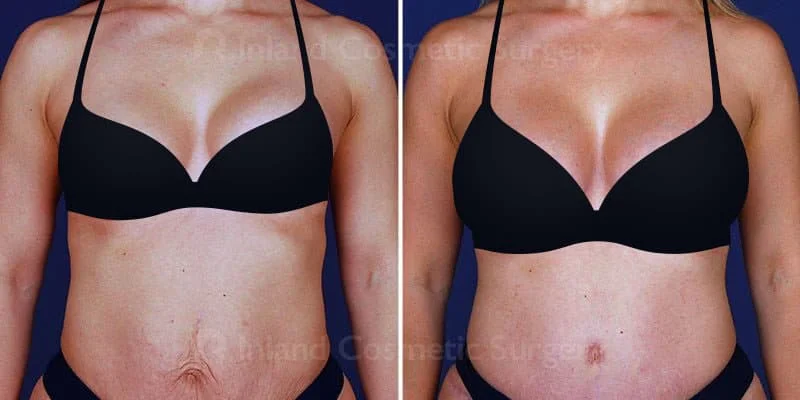 A Asymmetric breast enlargement within first trimester of