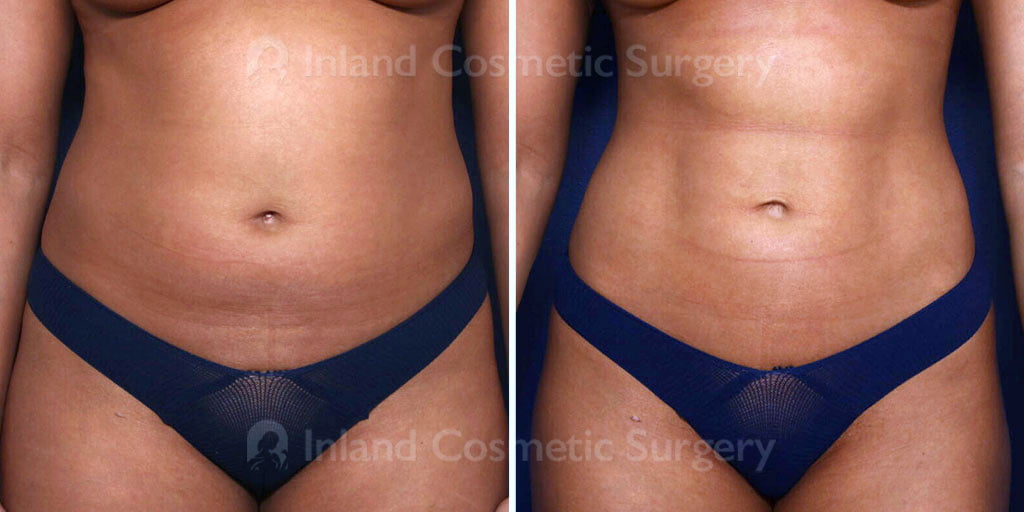 Before and after VASER lipo