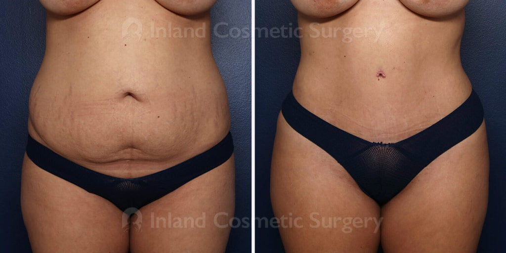 Before and after tummy tuck with liposuction