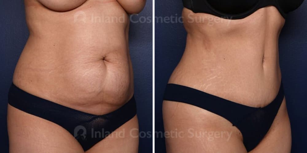 Inland Cosmetic Surgery Before and After patient image