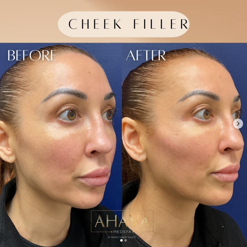 Real patient shown before and after cheek filler injections at Ahava Medpsa