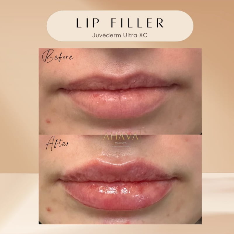 Real patient shown before and after lip filler injections at Ahava Medpsa