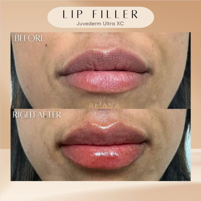 Real patient shown before and after lip filler injections at Ahava Medpsa