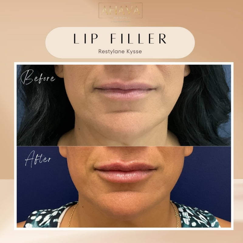 Real patient shown before and after lip filler injections at Ahava Medpsa