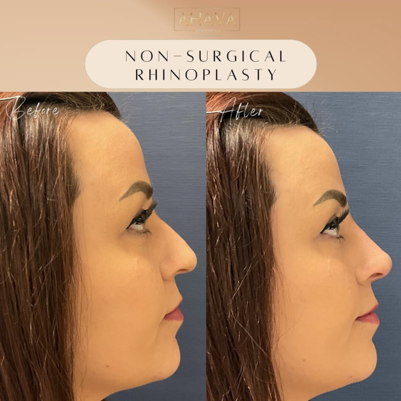 Real patient shown before and after non-surgical rhinoplasty with filler injections at Ahava Medpsa