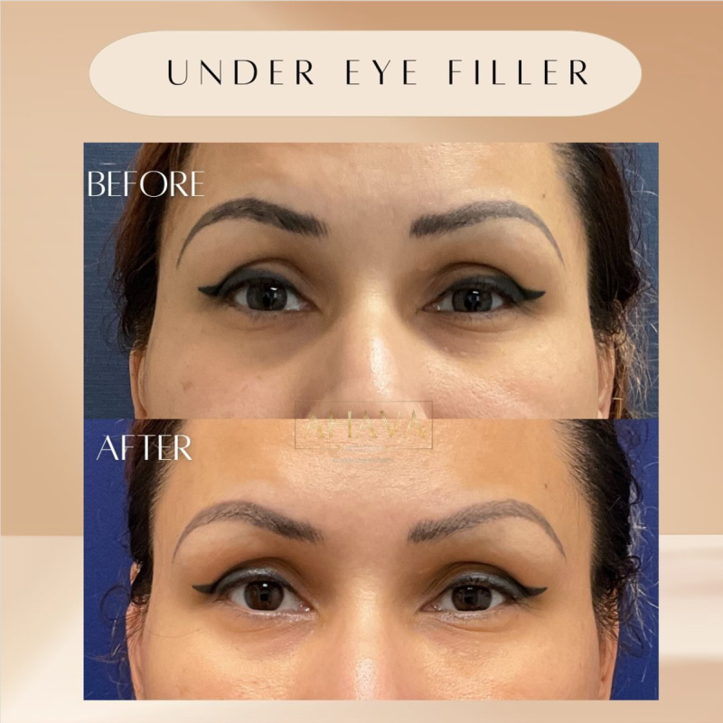 Real patient shown before and after under eye filler injections at Ahava Medpsa in Rancho Cucamonga