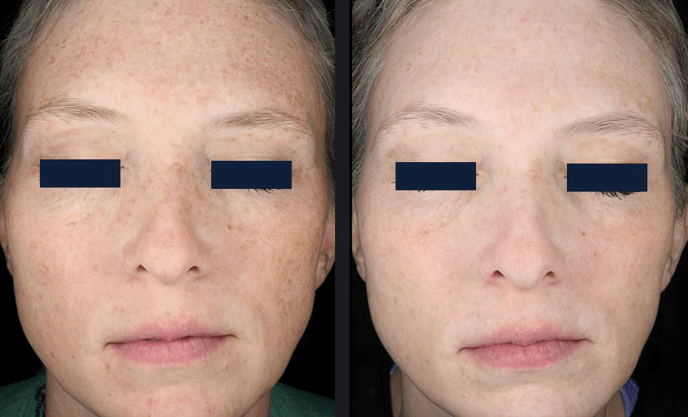 Before and after face treated with RF microneedling for reduced freckles and sun damage, bright skin, and fewer wrinkles in the cheeks and eye area