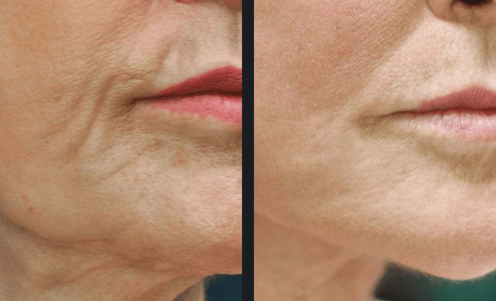 Tightened jowls and nasolabial folds after RF microneedling for facial aging