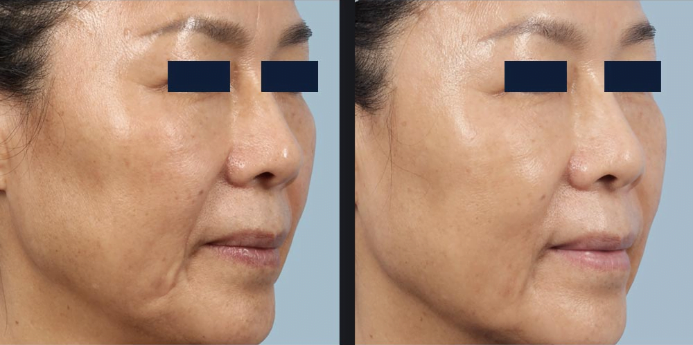 Before and after face skin treated with RF microneedling for reduced deep wrinkles around the mouth and jowls, naso-labial folds, and marionettes lines for a younger looking appearance