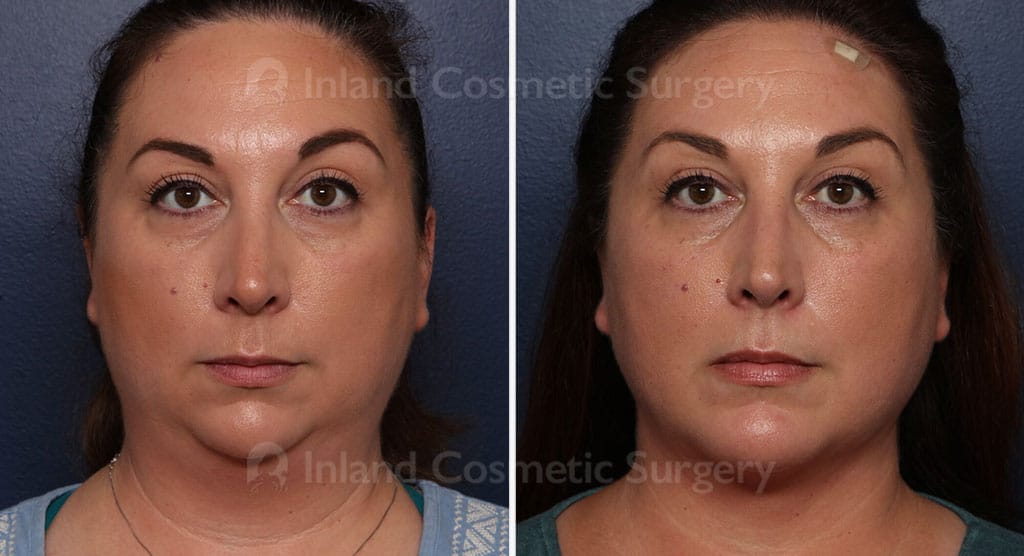 Chin Augmentation