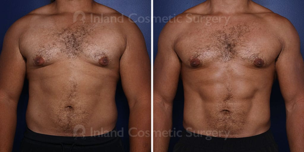 Male Breast Reduction