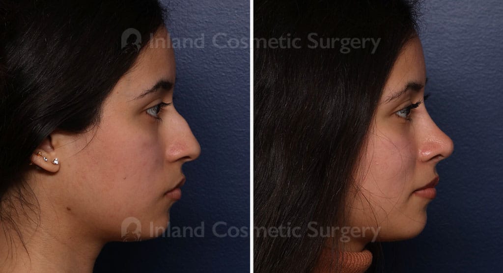 Rhinoplasty & Septoplasty