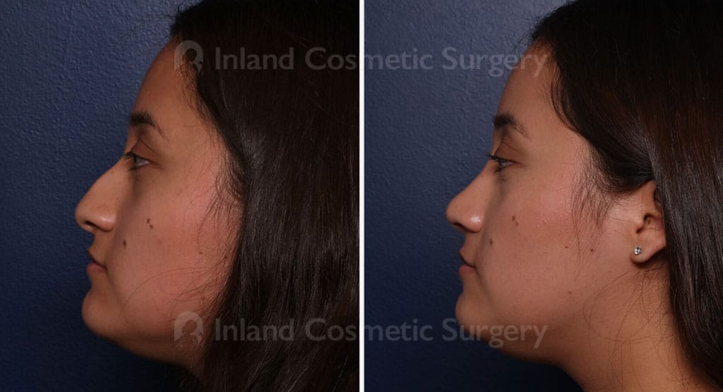 Rhinoplasty